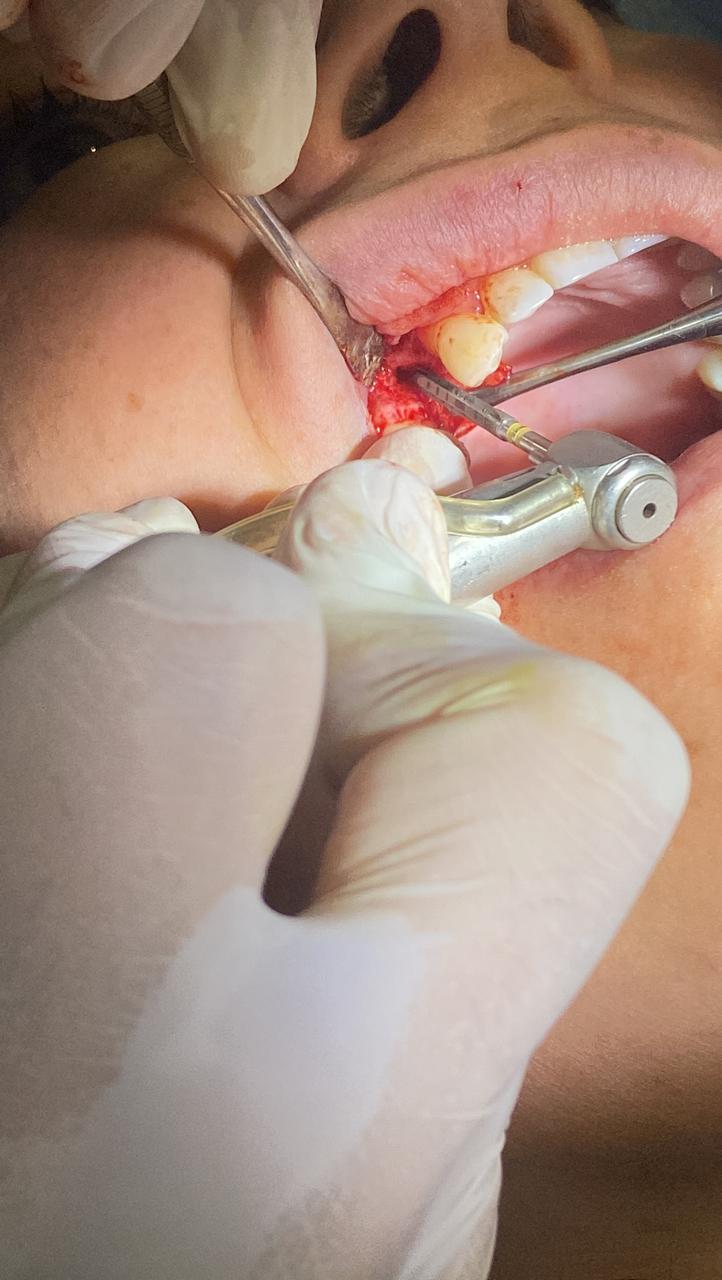 Detalle del procedimiento de implantes dentales en Dental Center Córdoba